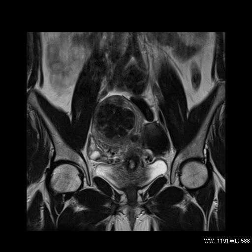 File:Broad ligament fibroid (Radiopaedia 49135-54241 Coronal T2 12).jpg