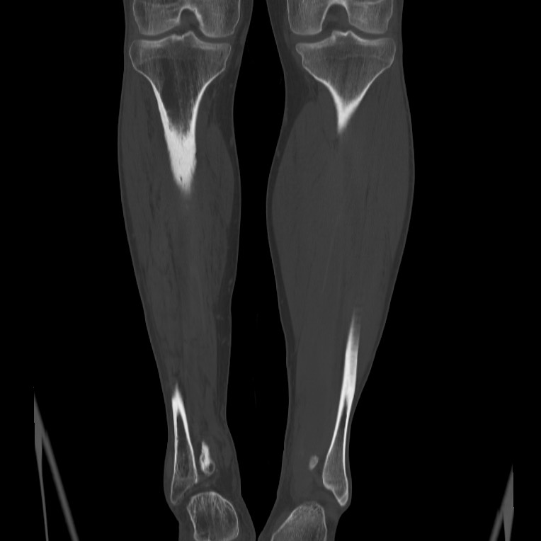 Brodie abscess - tibia (Radiopaedia 66028-75204 Coronal bone window 45).jpg