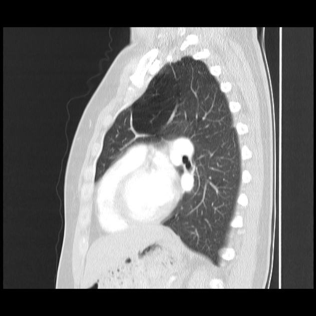 Bronchial atresia (Radiopaedia 22965-22992 Sagittal lung window 22).jpg