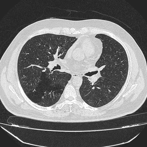 File:Bronchial atresia (Radiopaedia 58271-65417 Axial lung window 24).jpg