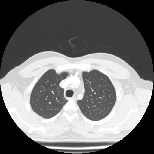 Bronchial carcinoid (Radiopaedia 80013-93291 Axial lung window 16).jpg