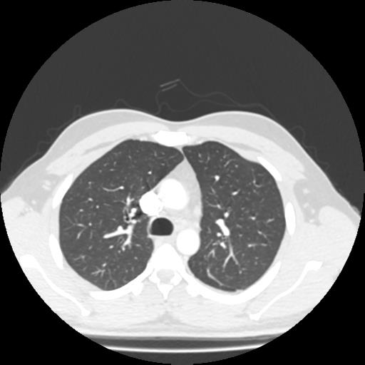 File:Bronchial carcinoid (Radiopaedia 80013-93291 Axial lung window 33).jpg