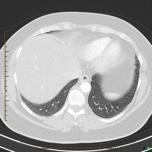 Bronchial diverticula (Radiopaedia 79512-92675 Axial lung window 39).jpg