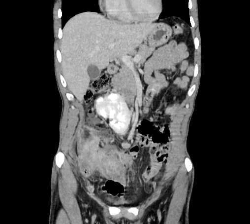 File:Bronchiectasis in Crohn disease (Radiopaedia 60311-67977 C 24).jpg