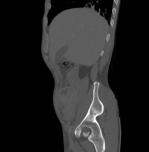 Bronchiectasis in Crohn disease (Radiopaedia 60311-67977 Sagittal bone window 39).jpg