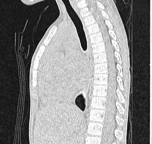 File:Bronchiolitis obliterans (Radiopaedia 71538-81897 Sagittal lung window 34).jpg
