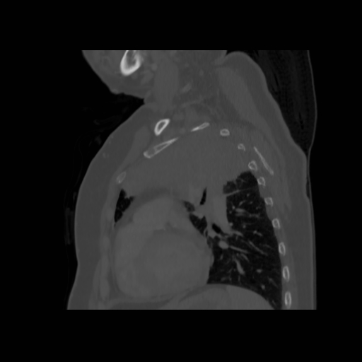 Bronchogenic carcinoma (Radiopaedia 73497-84262 Sagittal bone window 107).jpg
