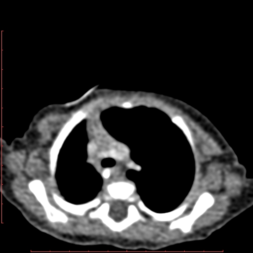 Bronchogenic cyst (Radiopaedia 78599-91409 B 61).jpg
