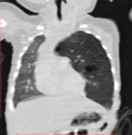Bronchogenic cyst (Radiopaedia 78599-91409 Coronal lung window 84).jpg