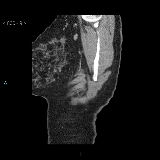 Bronchogenic cyst - posterior mediastinal (Radiopaedia 43885-47364 B 6).jpg