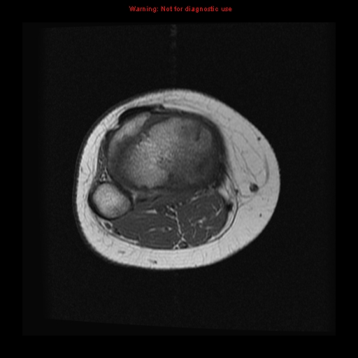 File:Brown tumor (Radiopaedia 12318-12597 Axial T1 12).jpg