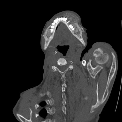 File:Brown tumor with secondary hyperparathyroidism (Radiopaedia 23591-23705 C 11).jpg