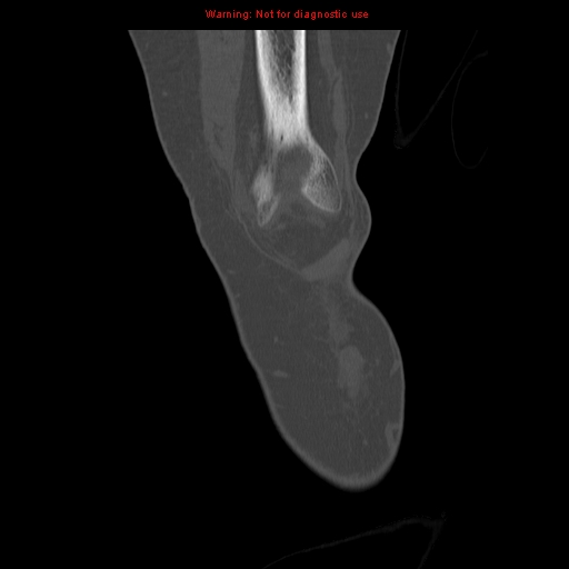 File:Brown tumors (Radiopaedia 9666-10291 Coronal bone window 2).jpg