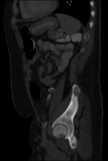 Brown tumors compressing the spinal cord (Radiopaedia 68442-77988 H 40).jpg