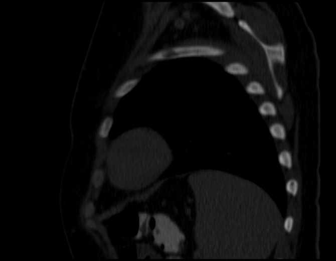 Brown tumors compressing the spinal cord (Radiopaedia 68442-77988 Sagittal bone window 47).jpg