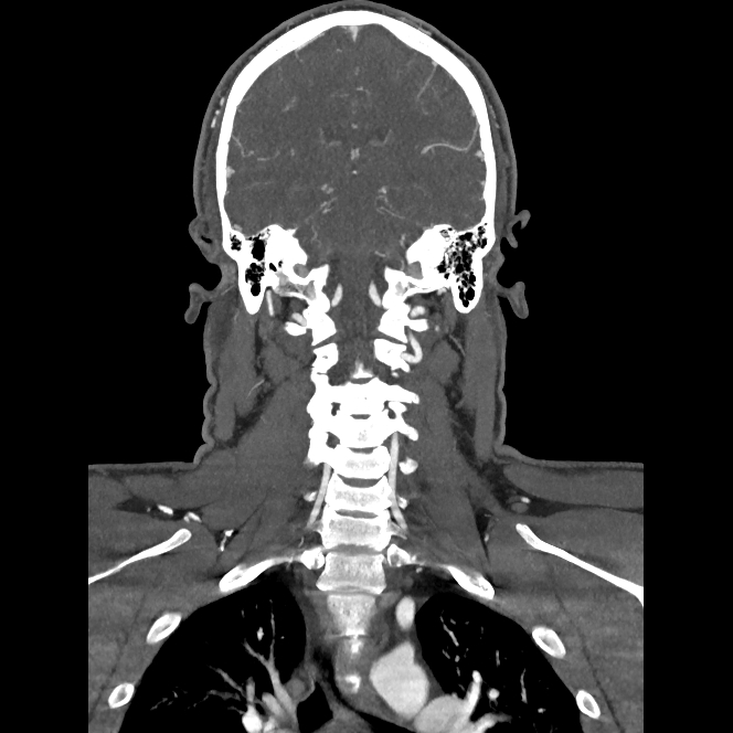 Buccal fat pad arteriovenous malformation (Radiopaedia 70936-81144 B 36).jpg