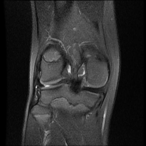 File:Bucket handle tear - lateral meniscus (Radiopaedia 72124-82634 Coronal PD fat sat 12).jpg