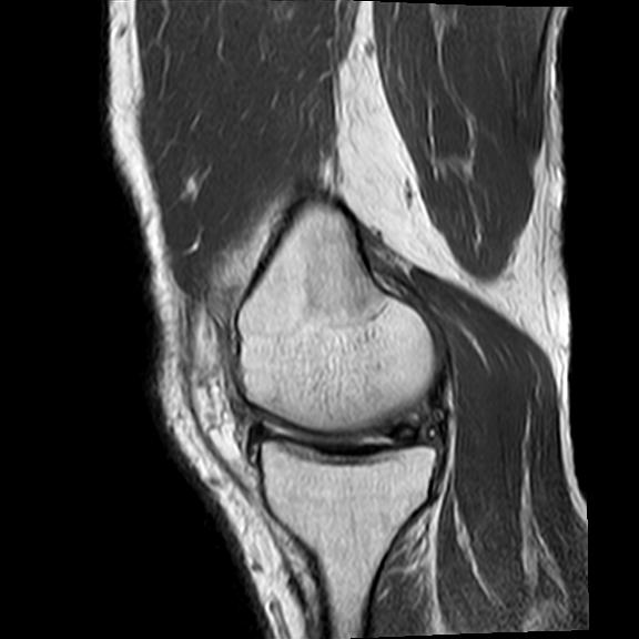 File:Bucket handle tear - medial meniscus (Radiopaedia 29250-29664 Sagittal PD 15).jpg