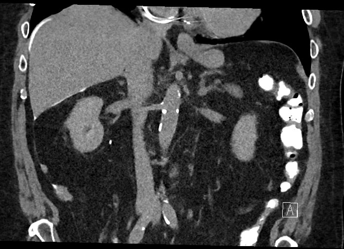 Buried bumper syndrome - gastrostomy tube (Radiopaedia 63843-72577 Coronal Inject 73).jpg