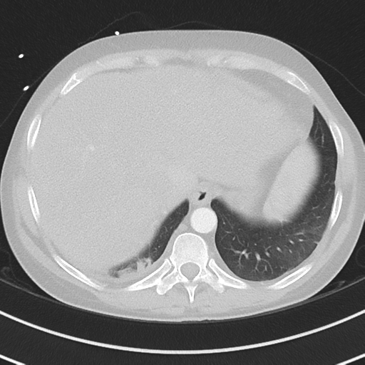 Burkitt lymphoma (Radiopaedia 34686-36121 Axial lung window 41).png