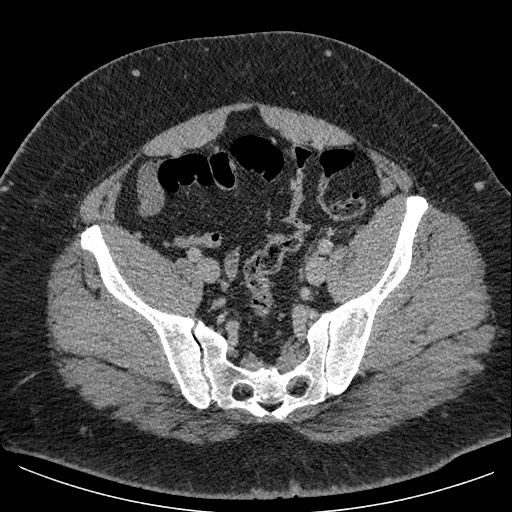 Burned-out testicular seminoma - retroperitoneal nodal metastases (Radiopaedia 62872-71245 A 59).jpg
