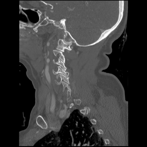 File:C1 anterior arch (plough) fracture - type 1 (Radiopaedia 76181-87720 Sagittal bone window 77).jpg