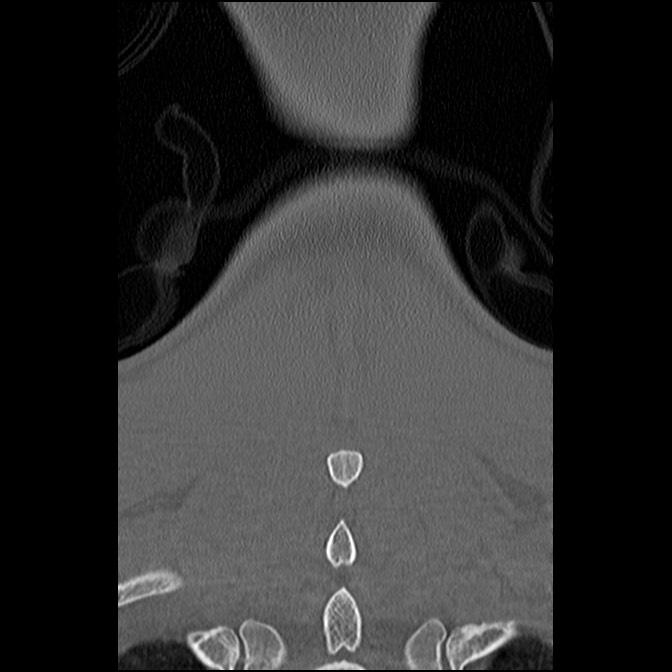 C5 facet fracture (Radiopaedia 58374-65499 Coronal bone window 57).jpg