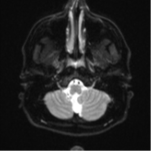 File:CNS vasculitis (Radiopaedia 55715-62263 Axial DWI 4).png