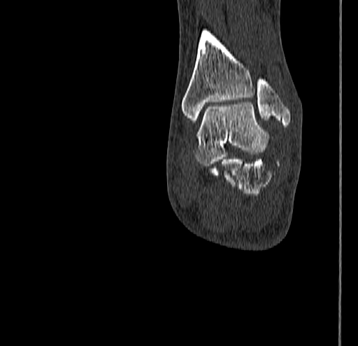 Calcaneal fracture - Sanders type 4 (Radiopaedia 90179-107370 Coronal bone window 66).jpg