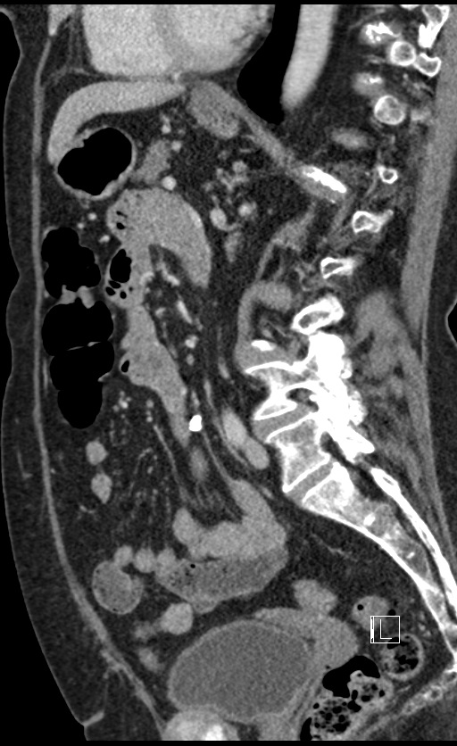 Calcified adrenal glands and Spigelian hernia (Radiopaedia 49741-54988 C 72).jpg