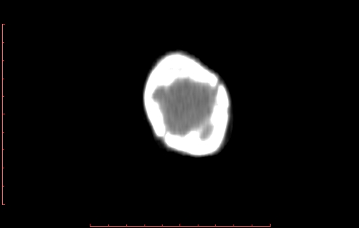 Calcified cephalohematoma (Radiopaedia 78775-91629 Coronal non-contrast 99).jpg