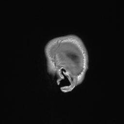 Callosal dysgenesis with interhemispheric cyst (Radiopaedia 53355-59335 Sagittal T1 10).jpg