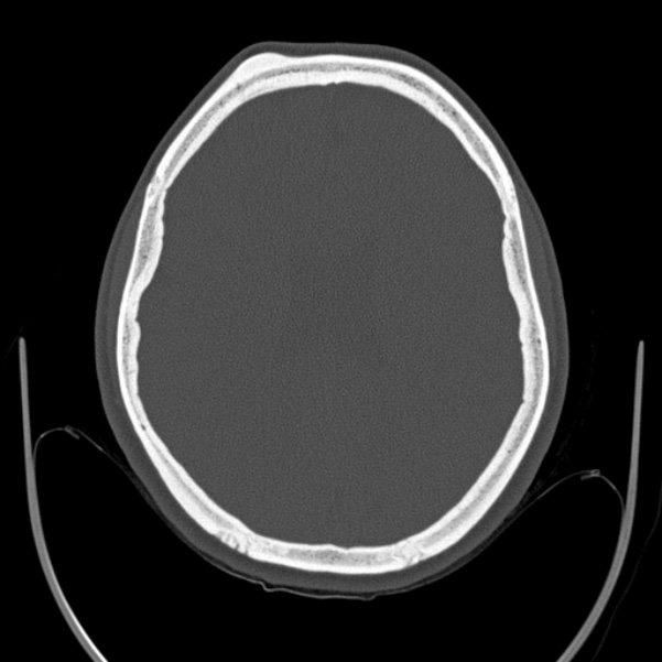 Calvarial osteoma (Radiopaedia 36520-38079 Axial bone window 68).jpg