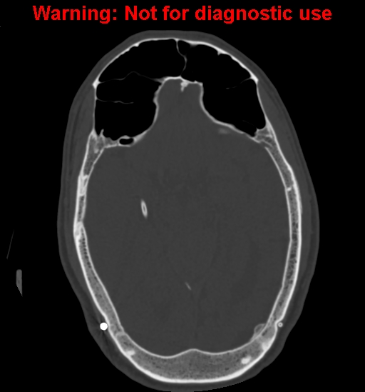 Calvarial thickening from chronic shunting (Radiopaedia 60079-67637 Axial bone window 81).jpg