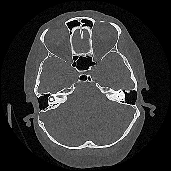 Canal up mastoidectomy (Radiopaedia 78108-90638 Axial bone window 88).jpg