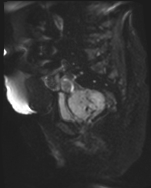 Cancer cervix - stage IIb (Radiopaedia 75411-86615 Sagittal DWI 33).jpg