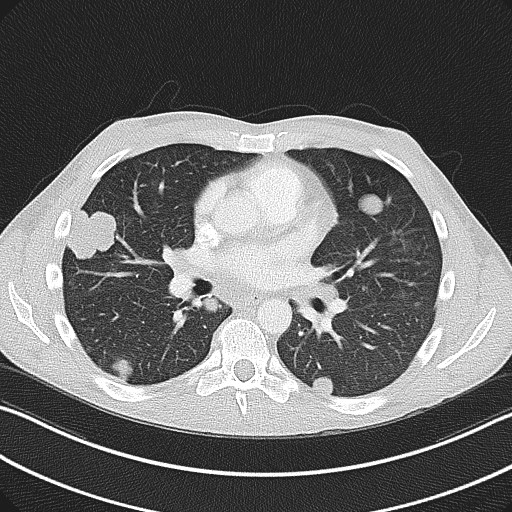 Cannonball metastases - testicular choriocarcinoma (Radiopaedia 84510-99891 Axial lung window 51).jpg