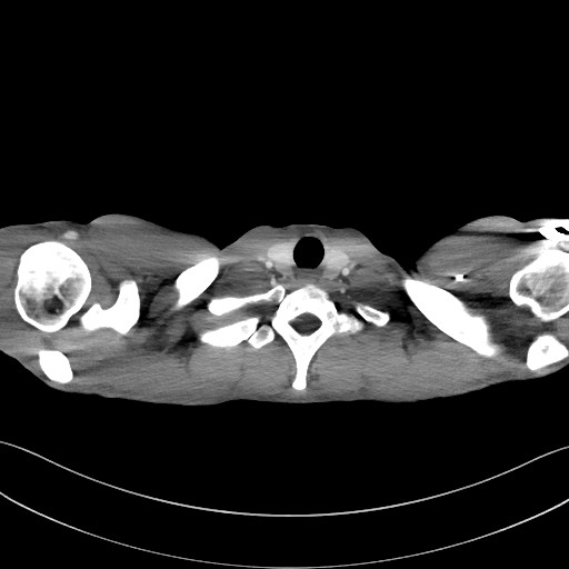 Cannonball metastases - testicular choriocarcinoma (Radiopaedia 84510-99891 B 13).jpg
