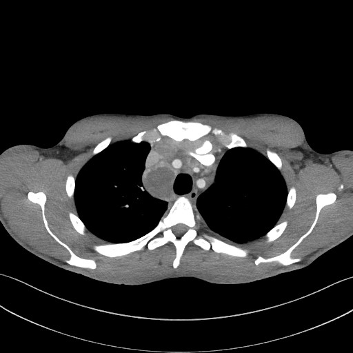 Cannonball metastases - testicular choriocarcinoma (Radiopaedia 84510-99891 B 34).jpg