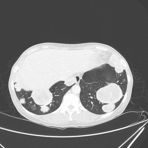 File:Canonball lung metastasis (Radiopaedia 77634-89837 Axial lung window 150).jpg