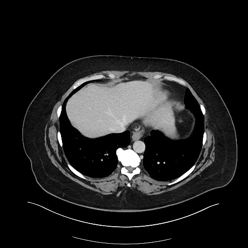 File:Carcinoid tumor - terminal ileum (Radiopaedia 60931-68739 Axial 109).jpg