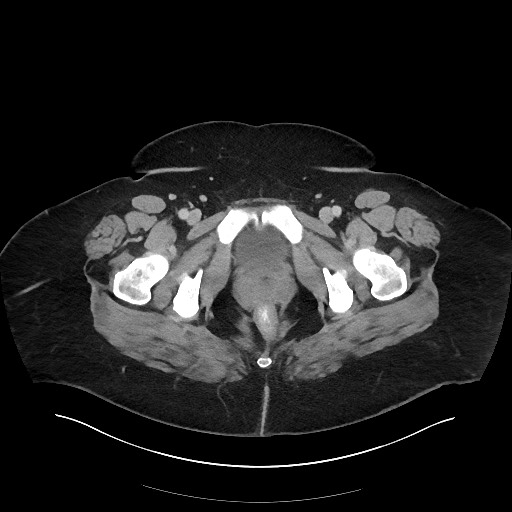 File:Carcinoid tumor - terminal ileum (Radiopaedia 60931-68739 Axial 134).jpg