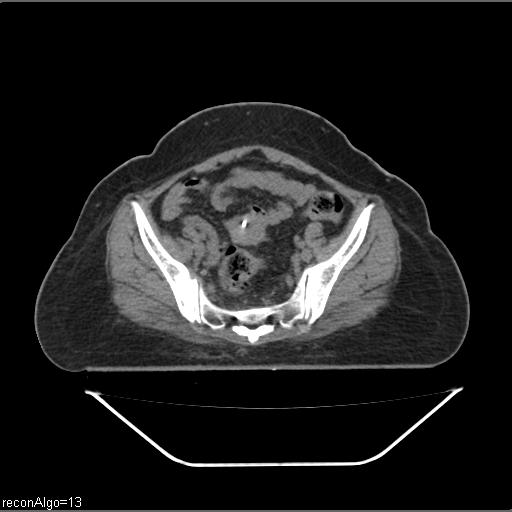Carcinoma cervix- brachytherapy applicator (Radiopaedia 33135-34173 Axial non-contrast 16).jpg