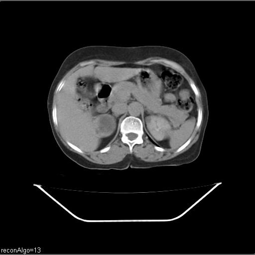 File:Carcinoma cervix- recurrence (Radiopaedia 34702-36137 B 66).jpg