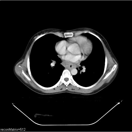 File:Carcinoma of esophagus (Radiopaedia 27356-27550 A 17).jpg