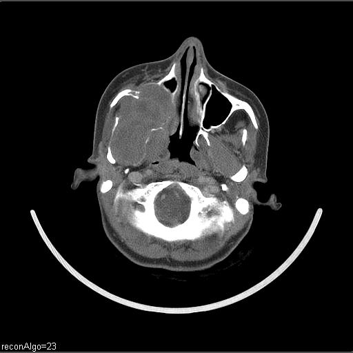 Carcinoma of the maxillary antrum (Radiopaedia 53805-59888 Axial C+ delayed 53).jpg