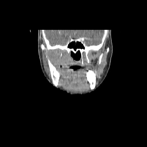 Carcinoma of the maxillary antrum (Radiopaedia 53805-59888 Coronal C+ delayed 64).jpg