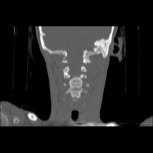Carcinoma of the maxillary antrum (Radiopaedia 53805-59888 Coronal bone window 104).jpg
