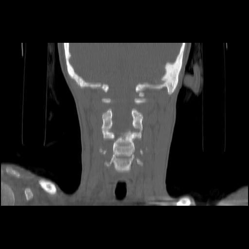 Carcinoma of the maxillary antrum (Radiopaedia 53805-59888 Coronal bone window 107).jpg