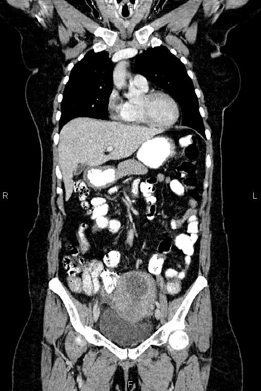 Carcinoma of uterine cervix (Radiopaedia 85861-101700 C 18).jpg